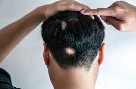 كل ما تحتاجون  معرفته عن داء الثعلبة